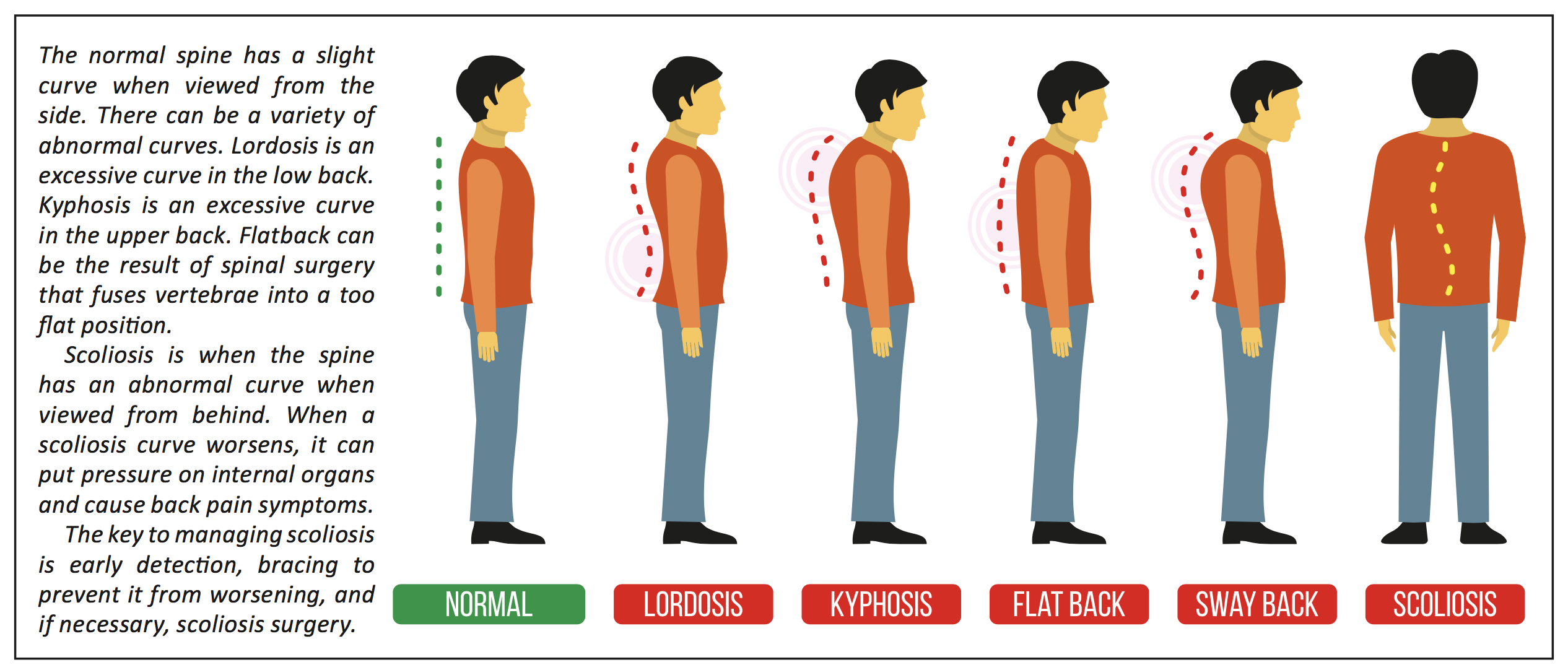 Scoliosis - Rory Mayer, MD