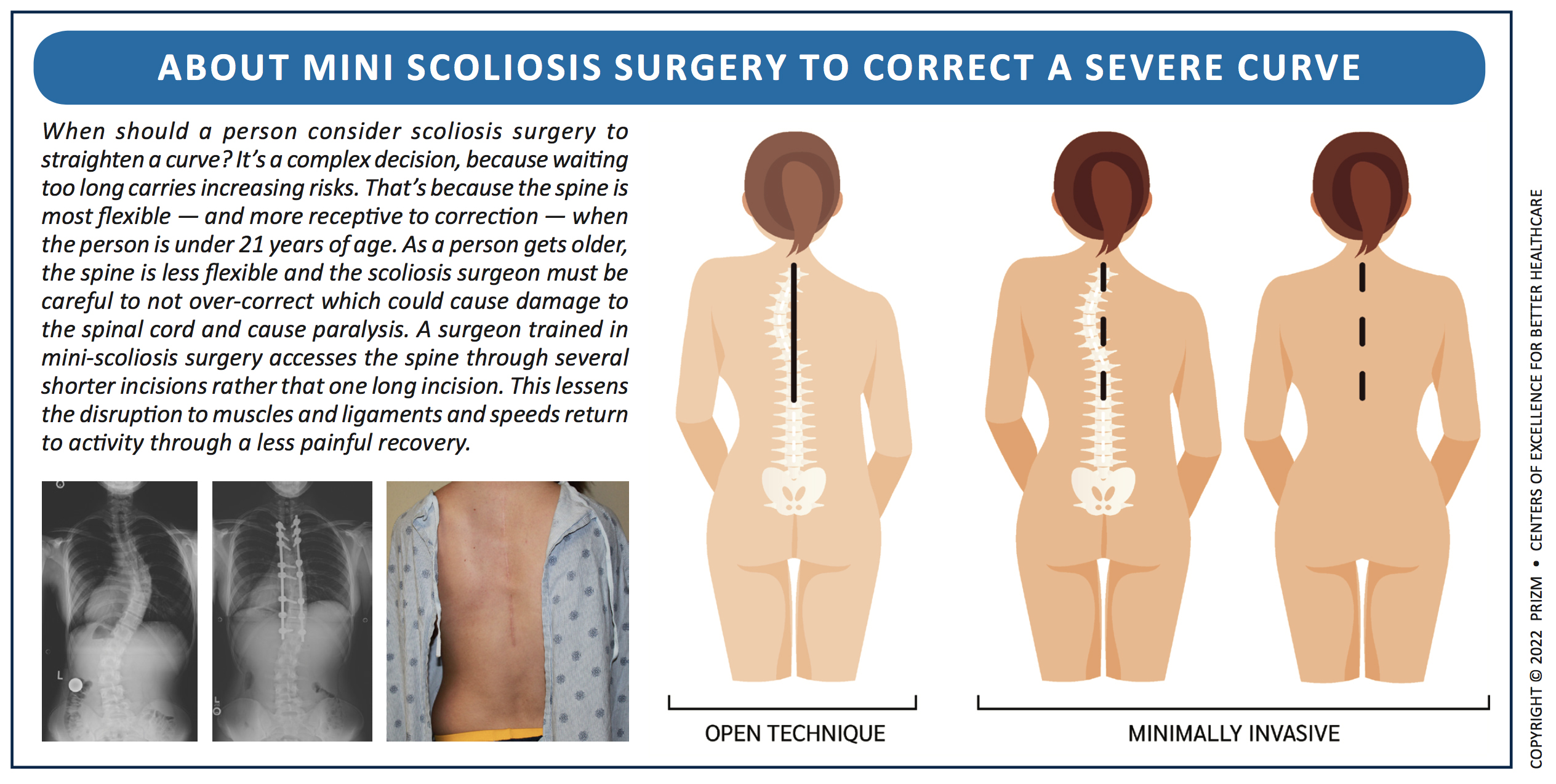 Scoliosis correction