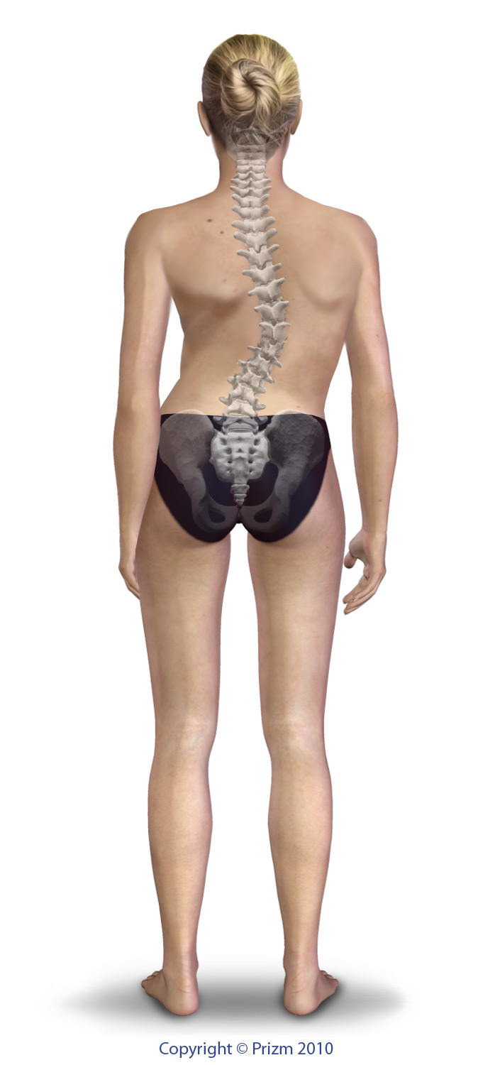 Scoliosis - Rory Mayer, MD